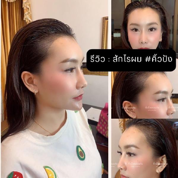 ปฏิเสธไม่ได้ถ้าปัญหาหัวล้าน ผมบาง สักไรผม คือคำตอบที่ใช่